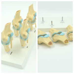 Le modèle de pathologie de l'articulation du genou en 4 étapes montre le processus de lésion de l'articulation du genou - Product Image 6