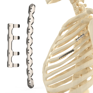 CANWELL Plaque de verrouillage des côtes en titane Fixation osseuse Implant orthopédique pour chirurgie des fractures CE ISO - Product Image 1