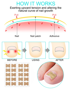 Patchs Correcteurs d'Ongles de Haute Qualité en Gros, Autocollants de Traitement Antifongique pour les Ongles des Pieds, Correction des Ongles, Kit de Manucure et Pédicure - Product Image 2
