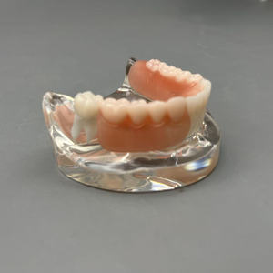 แบบจำลองการใส่รากฟันเทียมแบบถอดได้สำหรับการสาธิตทางทันตกรรมและการสื่อสารกับผู้ป่วย - Product Image 4