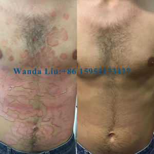 Lâmpada uvb altamente avançado para vitiligo best selling <span class=keywords><strong>Kernel</strong></span> Desk-Top Vitiligo UVB lâmpada para o tratamento da psoríase Light Therapy - Product Image 3