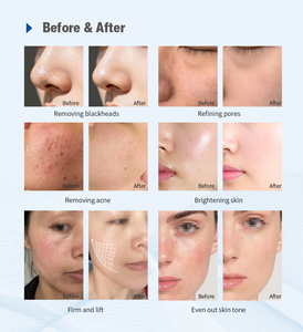 Appareil de beauté facial multifonctionnel de haute qualité pour les spas et salons commerciaux - Product Image 6