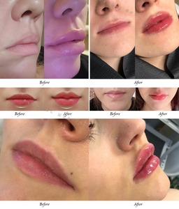 <span class=keywords><strong>Acide</strong></span> <span class=keywords><strong>hyaluronique</strong></span> Plurvel Red Lips à haute densité de liaison croisée pour l'industrie médicale - Product Image 5