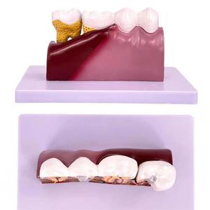 Modèle de caries dentaires pathologiques, modèle pédagogique complet de pathologie dentaire, modèle anatomique du dôme dentaire - Product Image 3
