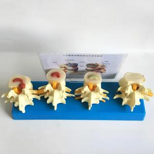 แบบจำลองโรคหมอนรอง<span class=keywords><strong>กระดูก</strong></span>สันหลังส่วนเอวของมนุษย์ 4 ขั้นตอน พร้อมการเปรียบเทียบโรค<span class=keywords><strong>กระดูก</strong></span>พรุน สำหรับการสอนด้านศัลยกรรม<span class=keywords><strong>กระดูก</strong></span> - Product Image 2