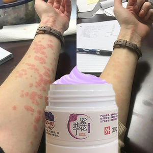 Natürlicher Pflanzenextrakt Anti-Juckreiz-Salbe für Hautreizungen & Bakterienhemmung |   Kräuter-Antibakterielle Hautcreme - Product Image 2