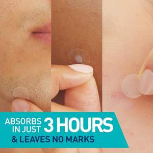 แผ่นปิดสิวไฮโดรคอลลอยด์ทรงกลมสำหรับรักษาสิวบนใบหน้า ด้วยเซราไมด์และไนอะซินาไมด์ ช่วยดูดซับน้ำมันและควบคุมจุดด่างดำ - Product Image 5