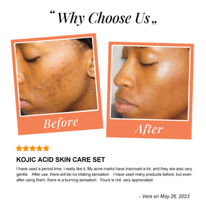 Private Label Hautaufhellendes Kojisäure-Serum, Stark Aufhellende Gesichtscreme, Bleichseife, Körperlotion, Hautöl, Hautpflegeset - Product Image 3