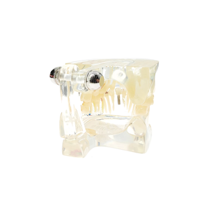 Modèle de dents pour maladies implantaire, conception claire, modèle d'étude des dents implantaire, modèle de pathologie <span class=keywords><strong>dentaire</strong></span> pour usage <span class=keywords><strong>dentaire</strong></span> - Product Image 6