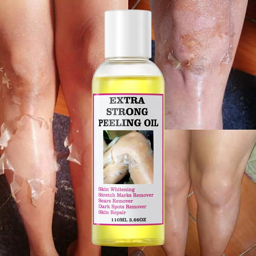 Super Strength Yellow Peeling Oil Lighten Elbows Knees Hands Melanin Bleaching Dark Skin Strong Peeling Oil