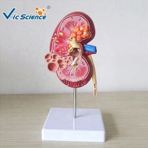 Medisch Wetenschappelijk Product Pathologisch Anatomiemodel Van Niercyste Nierziekte Model Menselijk Anatomiemodel - Product Image 1