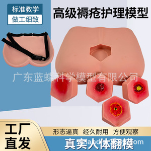 Modelo de cuidado de úlceras por presión por etapas, enseñanza de cuidado de ancianos, capacitación en el cuidado de úlceras por presión por etapas, cuidado de úlceras por presión - Product Image 3