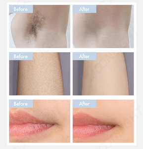 Cigno nero tripla lunghezza d'onda Pro Laser di depilazione 4 onde di raffreddamento analisi della pelle - Product Image 5