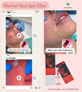 Plurvel Long-Lasting Ha Lip Plump Filler Injectable pour l'<span class=keywords><strong>augmentation</strong></span> <span class=keywords><strong>des</strong></span> lèvres, usage esthétique, 1 ml, lèvres rouges, crée <span class=keywords><strong>des</strong></span> lèvres rosées - Product Image 6