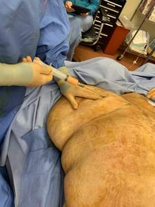 Fat Collection Transfer Fat Grafting Luer Lock Blunt Syringe Liposuction Cannula - Product Image 6