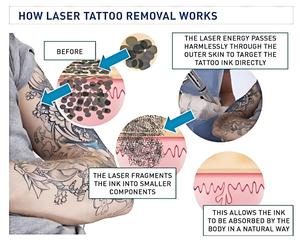 Peeling au carbone portable et peau de machine de détatouage au laser Yag picoseconde Machine laser 2 en 1 Pico et laser - Product Image 4