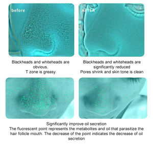 <span class=keywords><strong>Appareil</strong></span> d'Hydrodermabrasion Portable à Bulles, Extracteur <span class=keywords><strong>de</strong></span> Points Noirs Sous Vide, <span class=keywords><strong>Nettoyage</strong></span> Facial en Profondeur pour Soin <span class=keywords><strong>de</strong></span> la Peau - Product Image 6