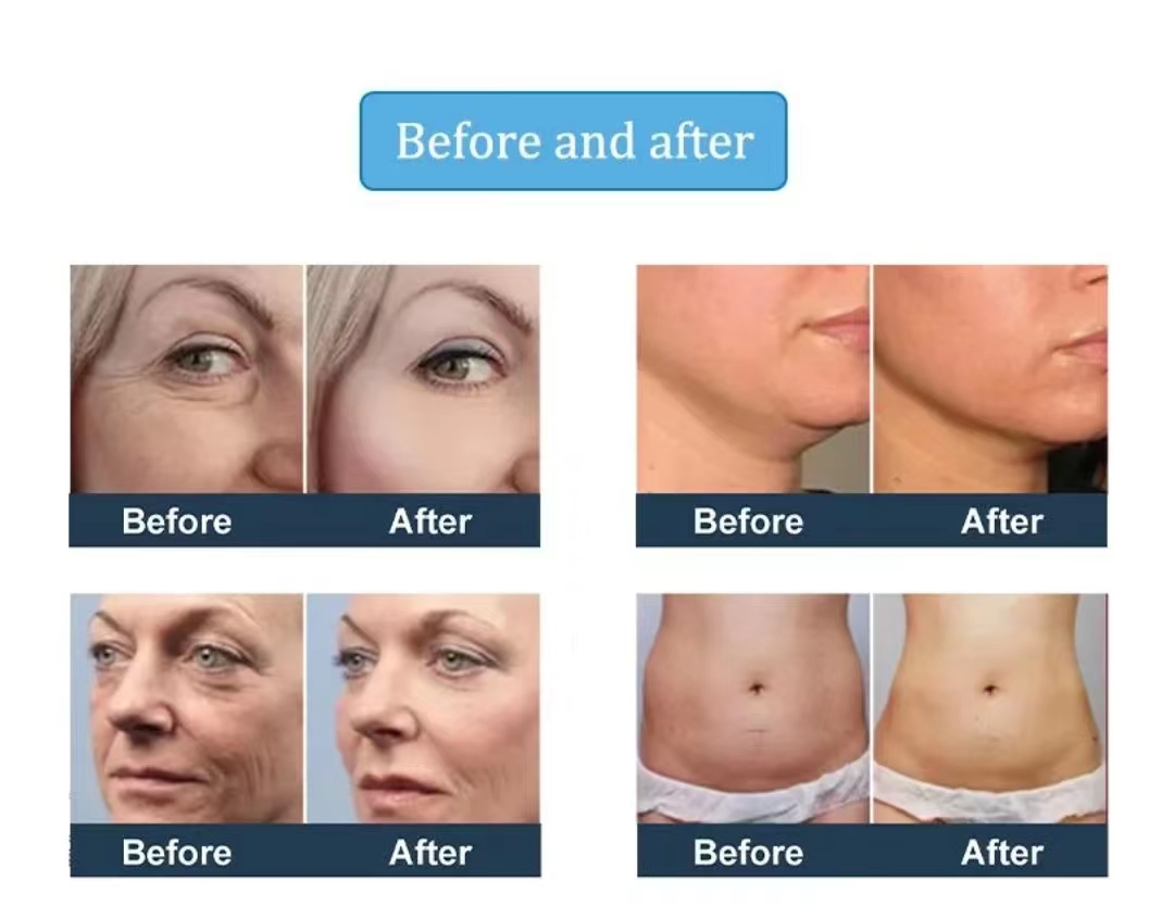 2023 New 8D HIFU Ultrasound Skin Tightening Machine Hifu Therapy For Face And Neck Lifting