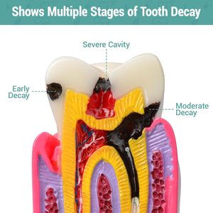 Modèle de démonstration de caries dentaires, modèle d'enseignement de l'anatomie dentaire pour l'éducation et l'explication aux patients - Product Image 3