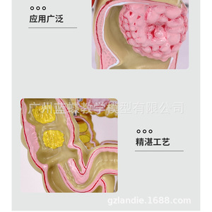 Modèle de simulation pédagogique de la pathologie du côlon, spécimen de lésion colorectale, communication médecin-patient sur les intestins, organe humain - Product Image 1