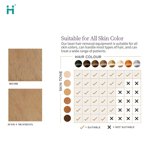 Appareil d'épilation laser diode et <span class=keywords><strong>pico</strong></span> 2-en-1 Huamei pour le retrait de tatouages et équipement de beauté - Product Image 4