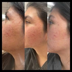 Appareil de soin du visage <span class=keywords><strong>sans</strong></span> <span class=keywords><strong>fil</strong></span>, stylo à aiguilles, outil de beauté portable pour une utilisation à domicile ou en salon - Product Image 6