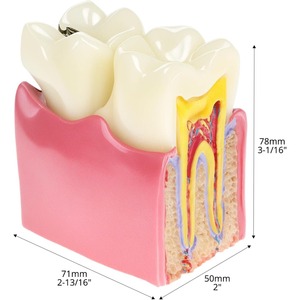 Modelo Educativo de Caries Dentales, Ampliado 6 Veces en Sección Transversal, Material de Resina para Educación Anatómica y Enseñanza de Salud Dental - Product Image 3