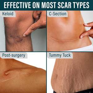 Cinta de Silicona de Grado Médico, Gruesa, Reutilizable, para Cicatrices - Product Image 2