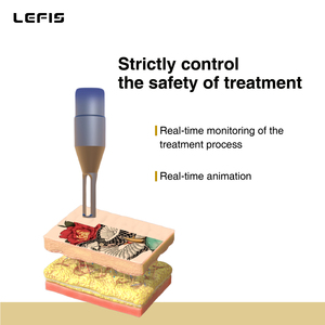 Équipement de suppression de tatouage au laser Nd Yag Q-Switch picoseconde réglable 1-10 Hz, nouveau design Lefis, pour clinique - Product Image 2
