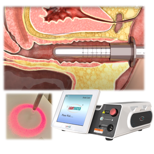 Irradiasi Laser 1470nm pada Dinding Vagina Peremajaan Vagina Perawatan Laser LVR Memperbaiki Masalah Inkontinensia Urin - Product Image 1