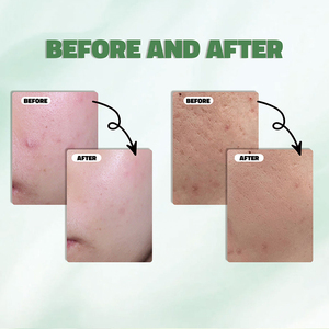 Suero Facial Hidratante <span class=keywords><strong>y</strong></span> Calmante con Ácido <span class=keywords><strong>Azelaico</strong></span> 10+ <span class=keywords><strong>y</strong></span> Ácido Hialurónico, 30 ml, Venta al Por Mayor - Product Image 6