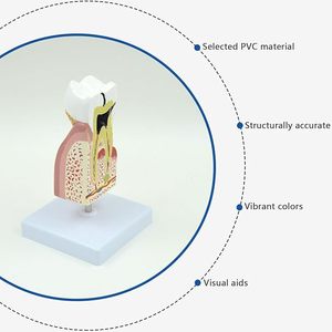 PVC đào tạo nha khoa con người bệnh lý răng sâu răng Mở rộng giải phẫu chính xác mô hình sâu răng cho các bài thuyết trình nha khoa - Product Image 2