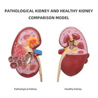 Modelo de Riñón Patológico y Normal - Simulación de Enseñanza de Urología, Modelo de Anatomía y Estructura del Riñón Humano