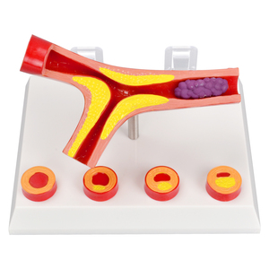 Modelo Anatómico de <span class=keywords><strong>Arteriosclerosis</strong></span> de 4 Partes con Sección Transversal de Arteria, Modelo de Ciencia Médica para Enseñanza Médica a Pacientes y Doctores - Product Image 3