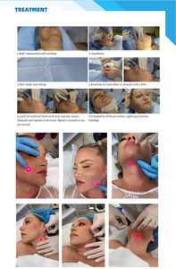 Láser Endolight 980 de 1470 nm, 60 W de Alta Potencia para Endolift - Product Image 5