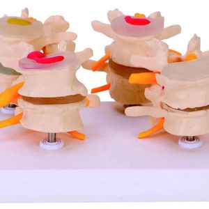 Vértebras lumbares con <span class=keywords><strong>hernia</strong></span> y <span class=keywords><strong>disco</strong></span> intervertebral sobresaliente Producto <span class=keywords><strong>de</strong></span> ciencia médica - Product Image 1