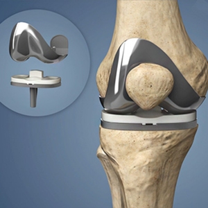 Prótesis para Fracturas Traumáticas, Inserto de Polietileno Altamente Reticulado, Implantes para Articulación de Rodilla - Product Image 3