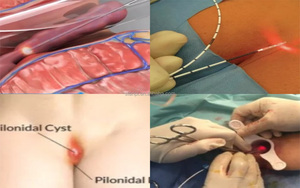 Eliminación de Hemorroides con Láser Portátil de 980nm y 1470nm, Diodo de Proctología para Hemorroidectomía, Fisura Anal, Fisura, Urología - Product Image 3