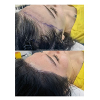 Kit de machine d'extraction de cheveux FUE avec stylo d'implantation et punch FUE portable 220V/110V 10000 tr/min