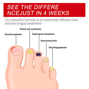 Suero Mejorado al por Mayor para Reparar Uñas Dañadas e Infectadas, Cuidado de los Pies para el Tratamiento de las Uñas de los Pies - Product Image 3