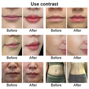 Inyector Profesional de 0.5ml sin Agujas <span class=keywords><strong>para</strong></span> Relleno de <span class=keywords><strong>Labios</strong></span>, Antiarrugas, Rejuvenecimiento Facial, Pistola de Mesoterapia de Acero Inoxidable - Product Image 6