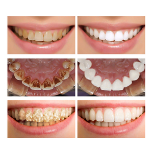 Poudre de sérum dentaire pour l'hygiène buccale, nettoyage et blanchiment des dents, élimine les taches de plaque dentaire - Product Image 5