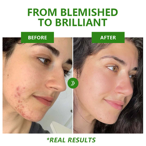 Serum Wajah Anti Penuaan, produk perawatan kulit Anti jerawat, Serum menyusutkan pori-pori, - Product Image 3