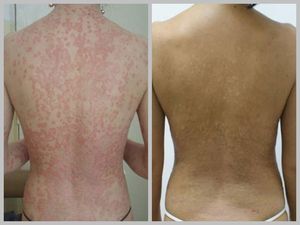 แผงฉายแสงยูวีบีรักษาด้วย KN-4004B ทางการแพทย์สำหรับโรคด่างขาวยูวีบี - Product Image 6