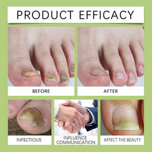 Tratamiento Líquido Antihongos para Uñas a Base <span class=keywords><strong>de</strong></span> Hierbas, Efecto Rápido, Limpia y Blanquea, 30 ml, Suero Natural para el Crecimiento y Renovación <span class=keywords><strong>de</strong></span> Uñas - Product Image 6