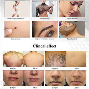 Diode 808 laser + ND Máy tẩy lông bằng laser hệ thống Android 15.6 inch 4K văn phòng phẩm USA thanh màn hình đa chức năng 2in1 - Product Image 3