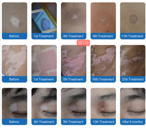 Draagbare Ce 308nm Excimer Laser Systeem Uvb Xecl Mini 308 Nm Laser Excimeer Voor Psoriasis Behandeling Vitiligo Laser Behandeling - Product Image 5