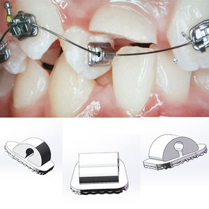 ท่อจัดฟันแบบยึดติดกับฟัน รุ่น Hot Sell Factory สำหรับฟันกรามซี่แรก แบบหลอดเดี่ยว ROTH/MBT ไม่สามารถแปลงรูปได้ ขนาด 0.018/0.022 - Product Image 1