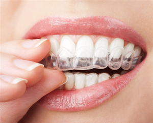 Plateaux de blanchiment des <span class=keywords><strong>dents</strong></span> Blanchiment des <span class=keywords><strong>dents</strong></span> Blanchisseur de <span class=keywords><strong>dents</strong></span> Protection buccale Soins de l'hygiène bucco-dentaire 2 paires de protège-<span class=keywords><strong>dents</strong></span> thermoformables - Product Image 1