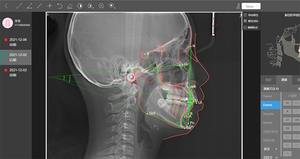 En Yeni Yılımda MEYER SS-X9010D Pro-3DE CBCT Panoramik Sefalometrik BT 3'ü 1 Arada Diş Kliniği Geniş Görüntü Alanlı Görüntüleme - Product Image 5
